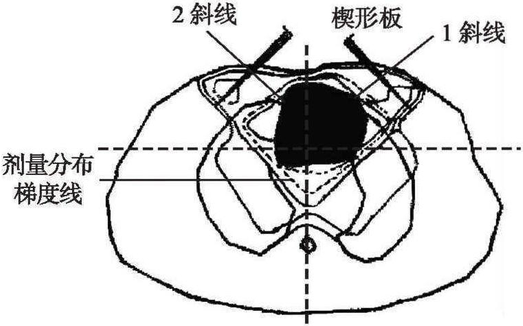 第五節(jié) 重癥肌無力的放射治療方法